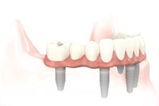 implante dental fijo
