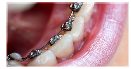 Ortodoncia de boca